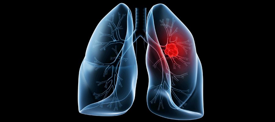 novel-mechanism-of-pleural-effusion-in-lung-cancer-patients-discovered