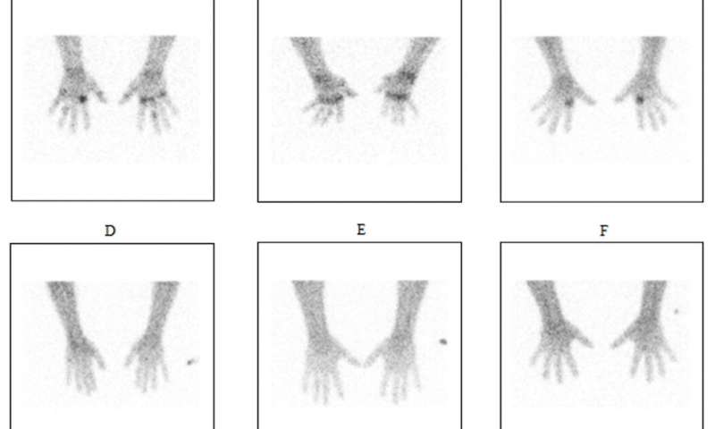 Non-invasive Molecular Imaging For Monitoring Rheumatoid Arthritis