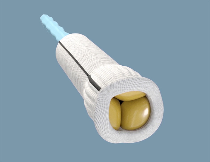 FDA Approves Edwards Lifesciences' Ready-To-Implant Aortic Valved Conduit - MedTechAsia