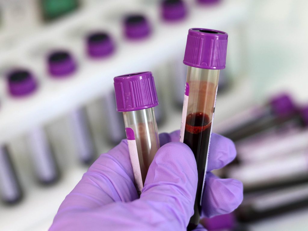 A Simple Blood Test Can Accurately Reveal Underlying Neurodegeneration ...