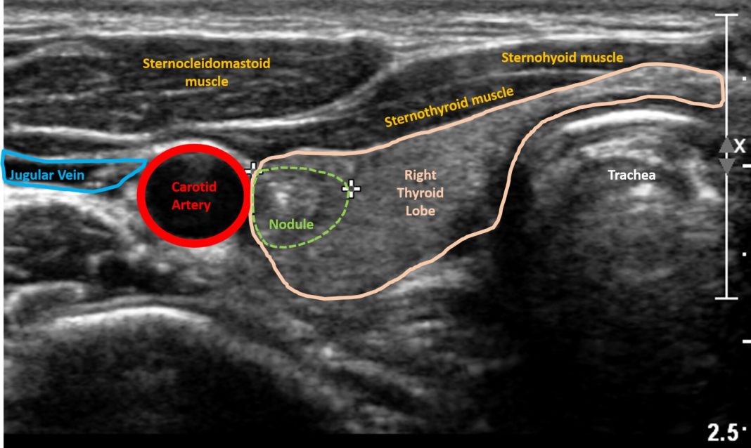 What Does Thyroid Tumor Look Like